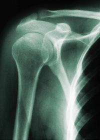 Frozen shoulder syndrome can respond to therapy