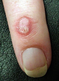 An overview of tips, products and methods for treating and curing Warts