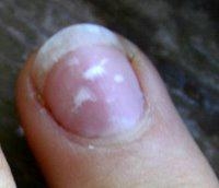 A barometer of general health, you should know why fingernails get white spots