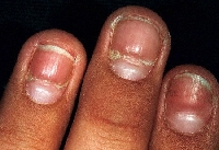 Something benign - or not so benign - may be what causes ridges on fingernails