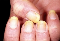How to get rid of yellow fingernails depends on what caused the discoloration