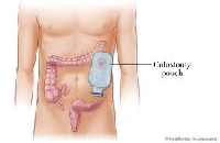 A colostomy can, at times, be reversed once the bowels have healed