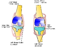 Understanding what causes knee instability can be a complicated medical question