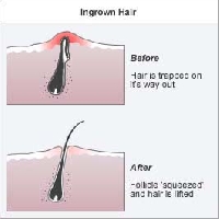 Getting rid of ingrown hairs is a challenge for people with this skin condition