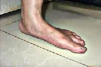 People who wear orthotic shoes include suffers of foot malfunction and pain