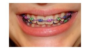 One of the top ten mouth guard instructions