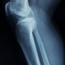 A list of the top ten diseases of the elderly