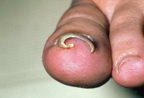 ingrown toenail