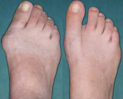 bunion
