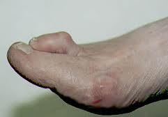 hammer toes