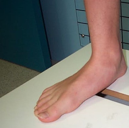 flat feet