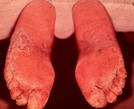 athletes foot
