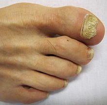 Oncymycosis