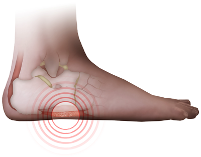 Plantar Fasciitis
