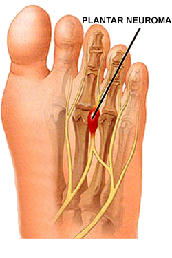 neuroma