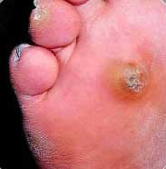 corns and calluses