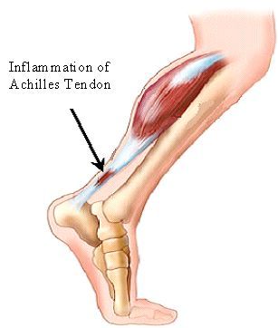 achilles tendon