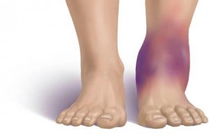 ankle sprain