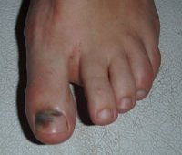 black toenail