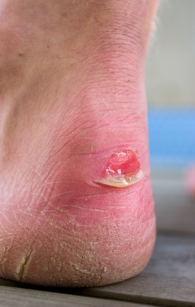 blister heel