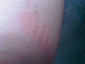 chafing