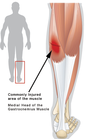 muscle pull