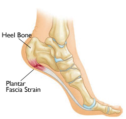 plantar fascitis