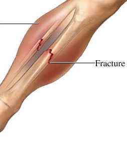 stress fracture