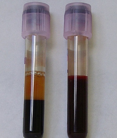 Blood Disorders