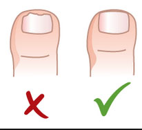 Trim toenails often