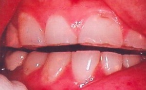 Bruxism