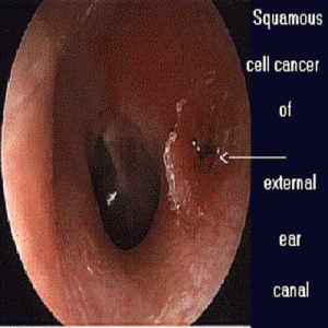 Tumors or Growths