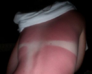 Sunburn Treatment